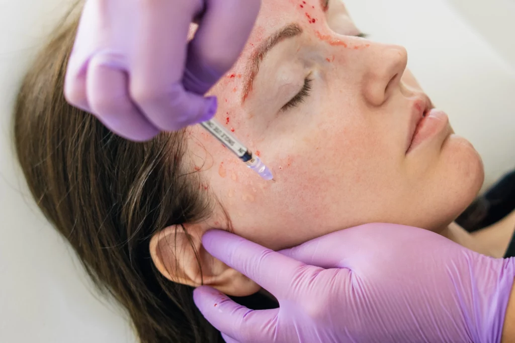 Vampire Facial Treatment in Noida